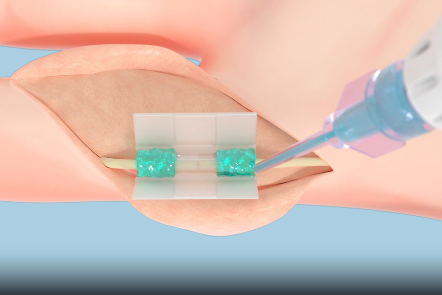 Revolutionary Sutureless Biopolymer Technology Enhancing Tissue Repair in Surgery